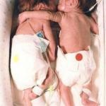 Эти близнецы, брат и сестра, родились раньше срока, и состояние девочки было очень тяжелым.  